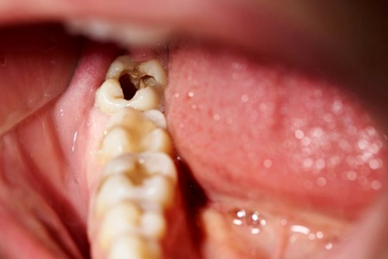 Thế nào là răng sâu nặng?