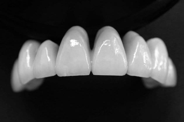 Tìm hiểu về răng sứ Cercon và Cercon HT