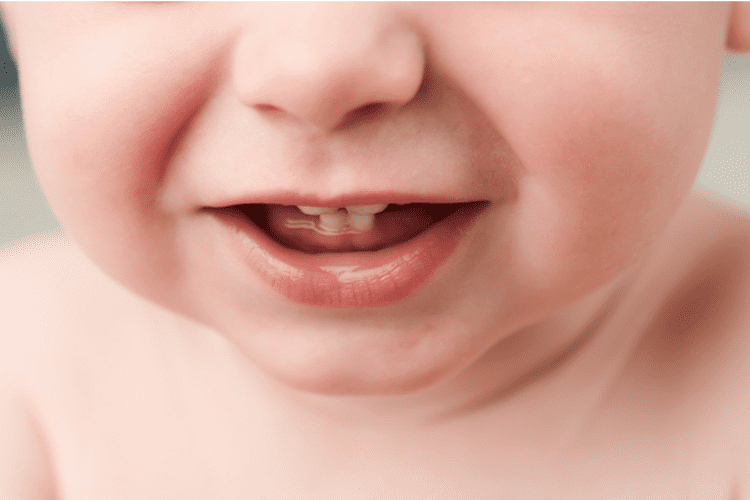 Tình trạng trẻ em bị sâu răng sữa sớm đang ở mức báo động