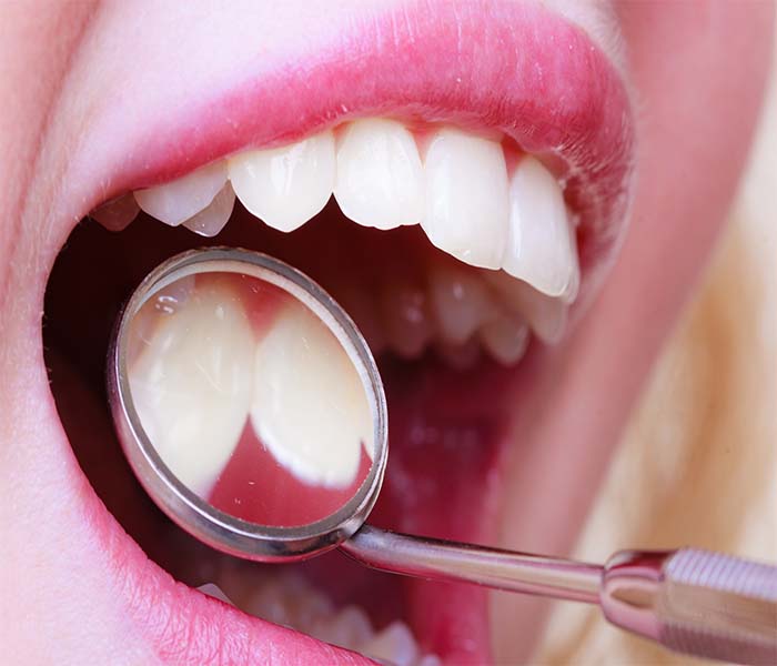 Trường hợp nên thực hiện dán sứ Veneer 2 răng cửa?