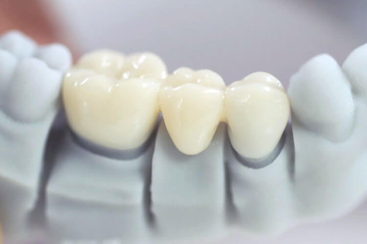 Trường hợp nên và không nên tiến hành bọc răng sứ răng cấm?