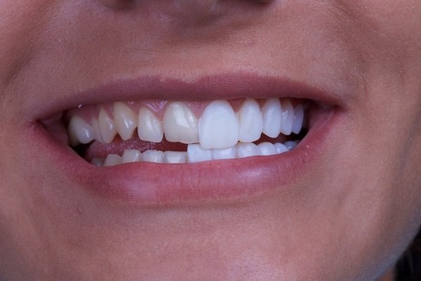 Ưu điểm và hạn chế khi dán răng sứ Veneer