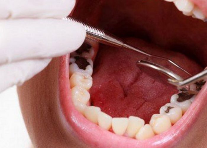 Trẻ em bị sâu răng hàm phải làm gì?