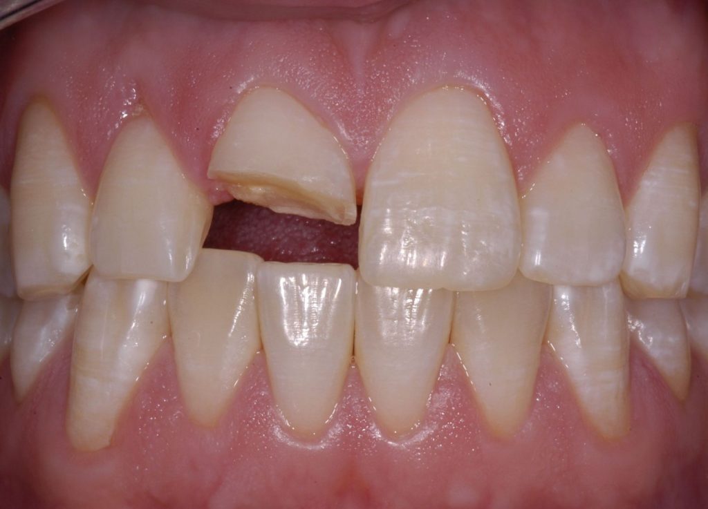 Tại sao nên bọc răng sứ cho răng cửa bị mẻ?
