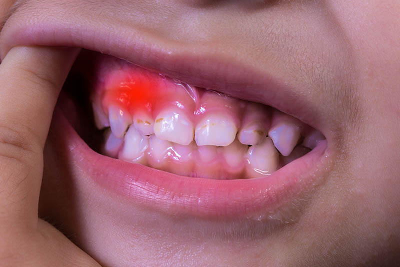 chăm sóc răng cho trẻ em bị viêm nướu tại phòng khám