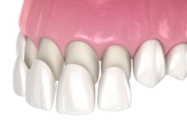 Trường hợp nào nên thực hiện dán răng sứ Veneer?