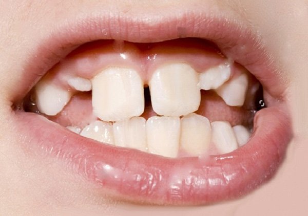 dấu hiệu cha mẹ có thể nhận biết khi răng trẻ em bị mọc lệch