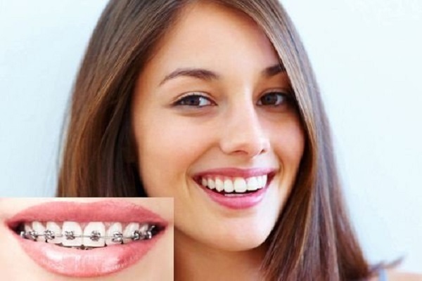 Niềng răng ở người lớn có còn hiệu quả không?