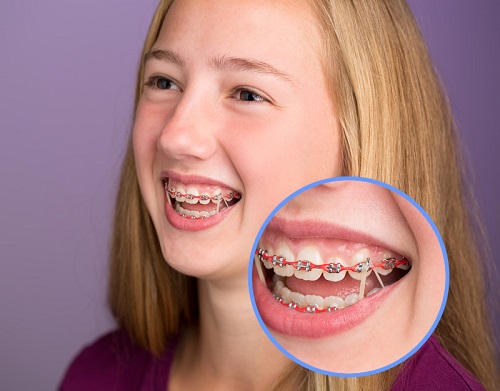 Xử lý niềng răng bị lòi chân răng như thế nào?