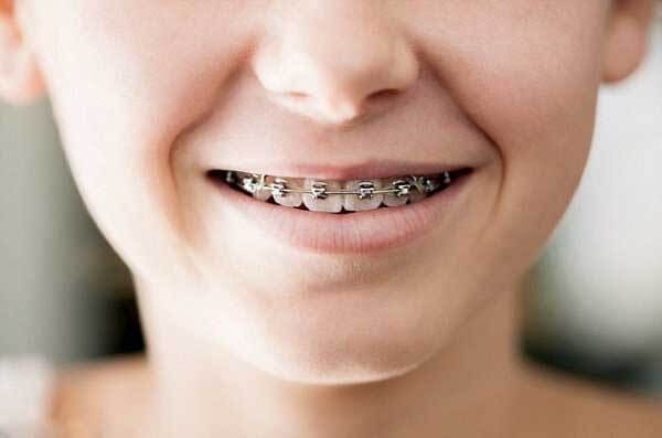 Có nên niềng răng cho trẻ 8 tuổi không?
