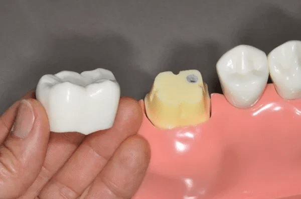 Răng sâu nặng có bọc sứ được không?