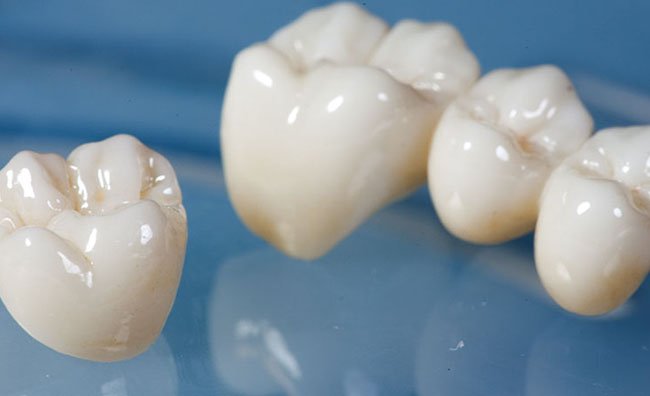 Những nhược điểm của răng sứ Cercon là gì?