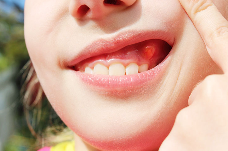 Phòng tránh tình trạng trẻ bị sưng nướu răng có mủ như thế nào?