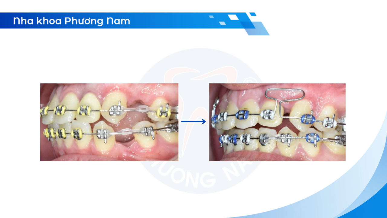 cac-giai-doan-nieng-rang