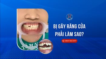 rang-cua-bi-gay-phai-lam-sao