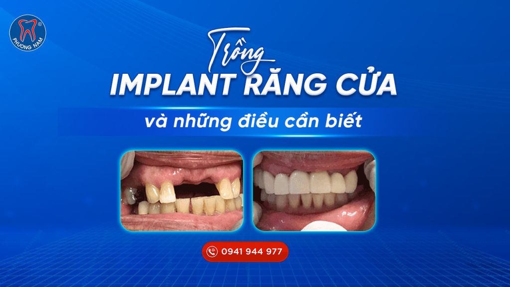 trong-rang-implant-rang-cua