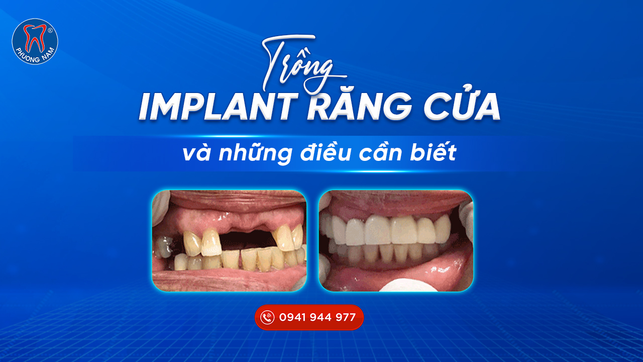 trong-rang-implant-rang-cua