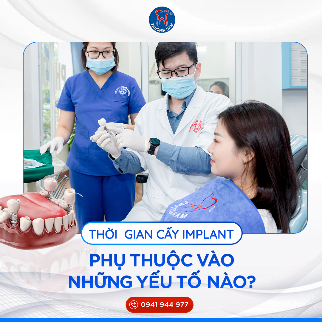 thoi-gian-cay-ghep-implant-mat-bao-lau