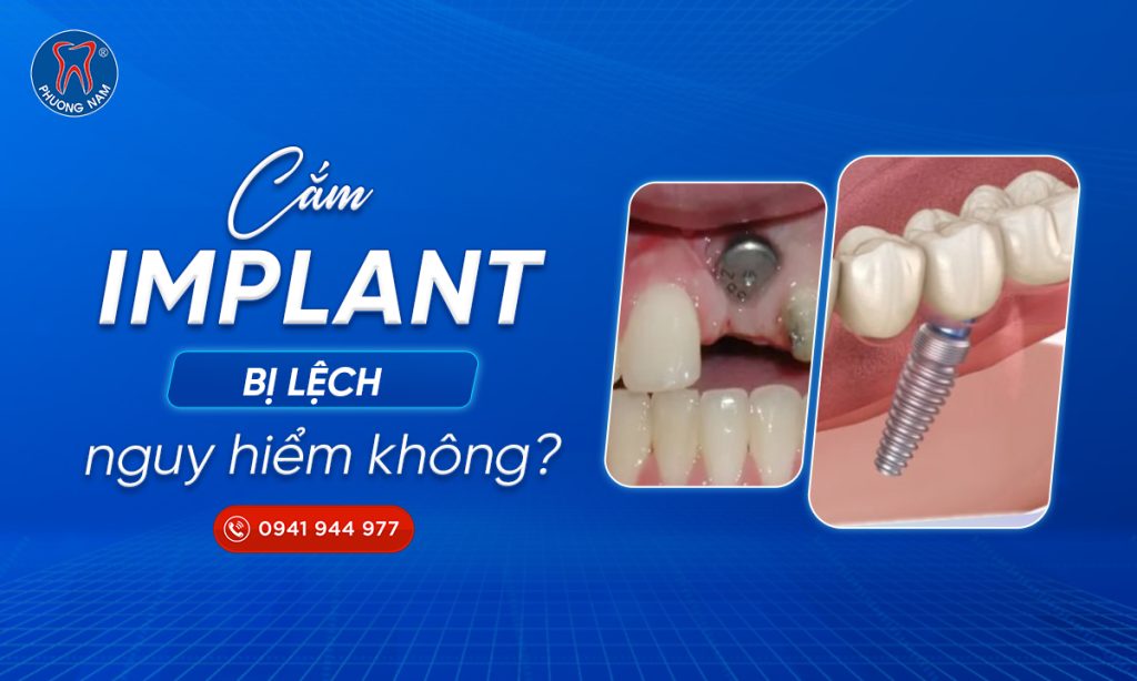 cam-implant-bi-lech