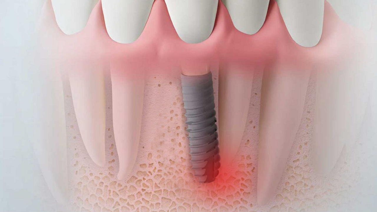 cam-implant-bi-lech-co-nguy-hiem-khong-1