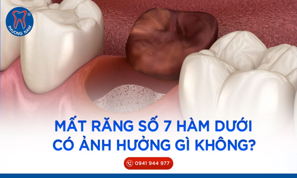 mat-rang-so-7-ham-duoi