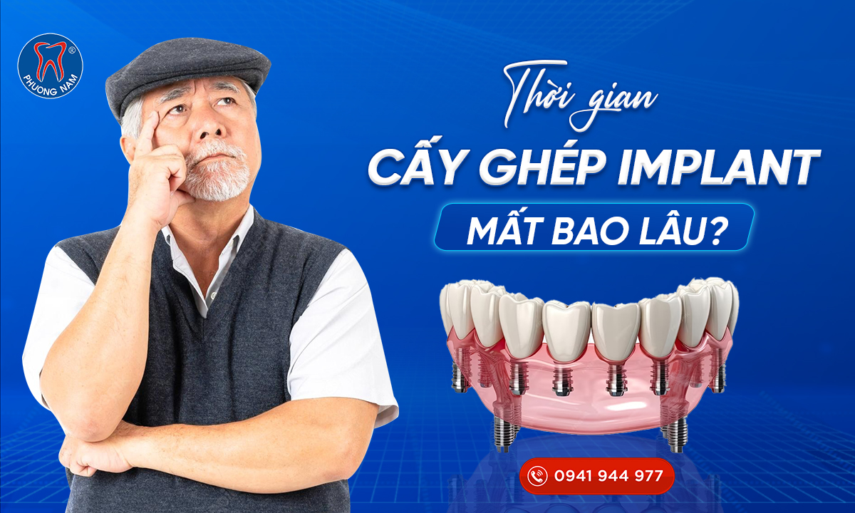 thoi-gian-cay-ghep-implant-mat-bao-lau