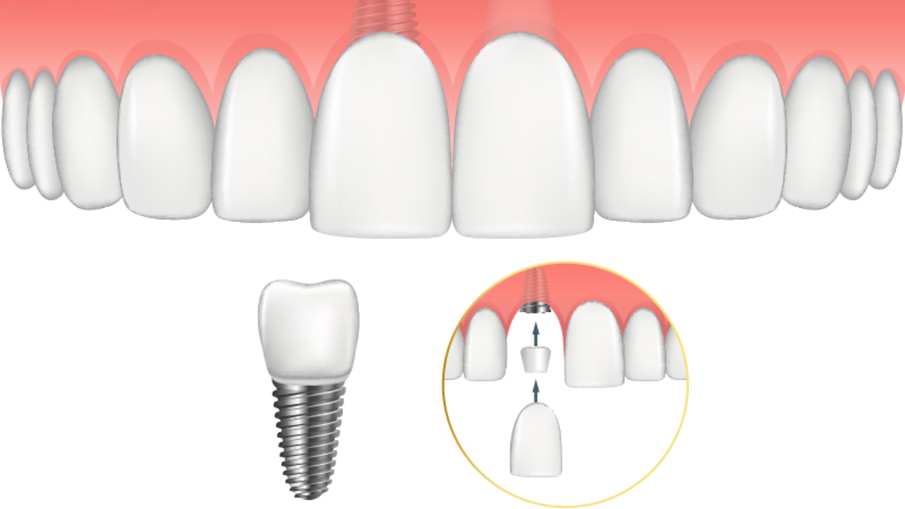 trong-implant-rang-cua