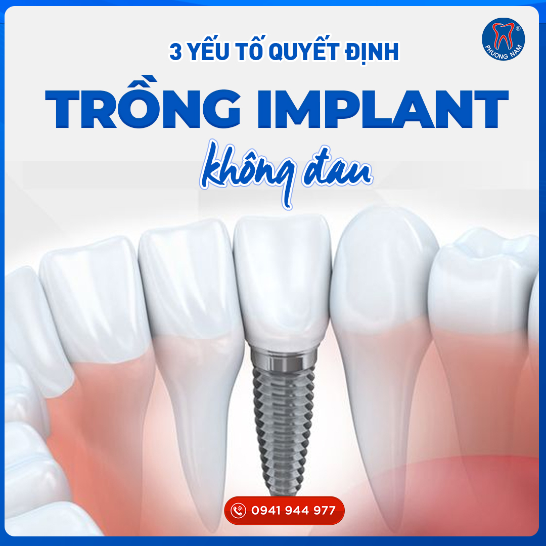 trong-rang-implant-co-dau-khong - 1