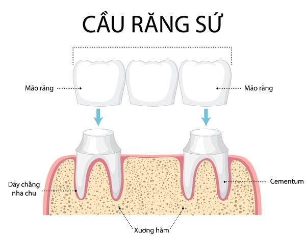 cau-rang-su-co-ben-khong