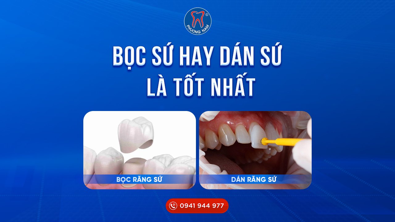 răng sứ hay dán răng sứ