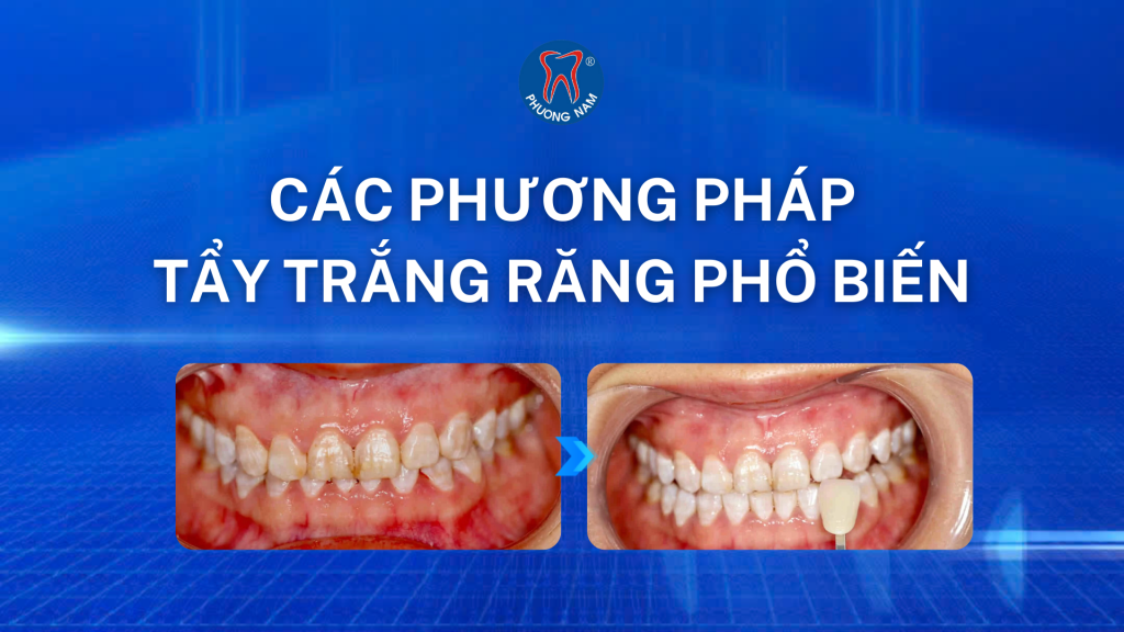 cac-phuong-phap-tay-trang-rang