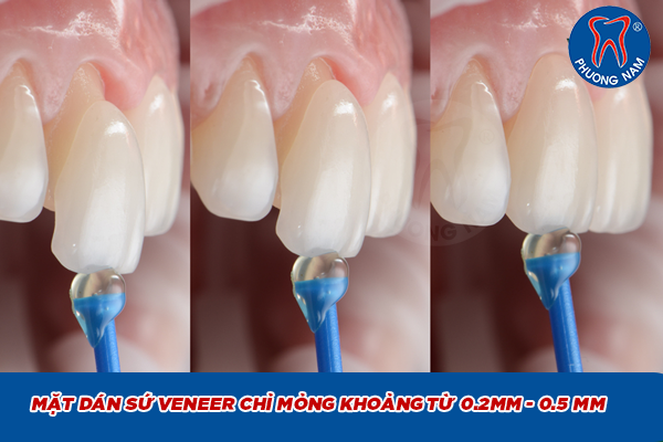 Mặt dán sứ veneer siêu mỏng 0.2mm – 0.5mm tại Nha khoa Phương Nam