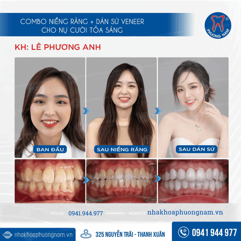 Combo niềng răng và dán sứ veneer trước và sau điều trị tại Nha khoa Phương Nam