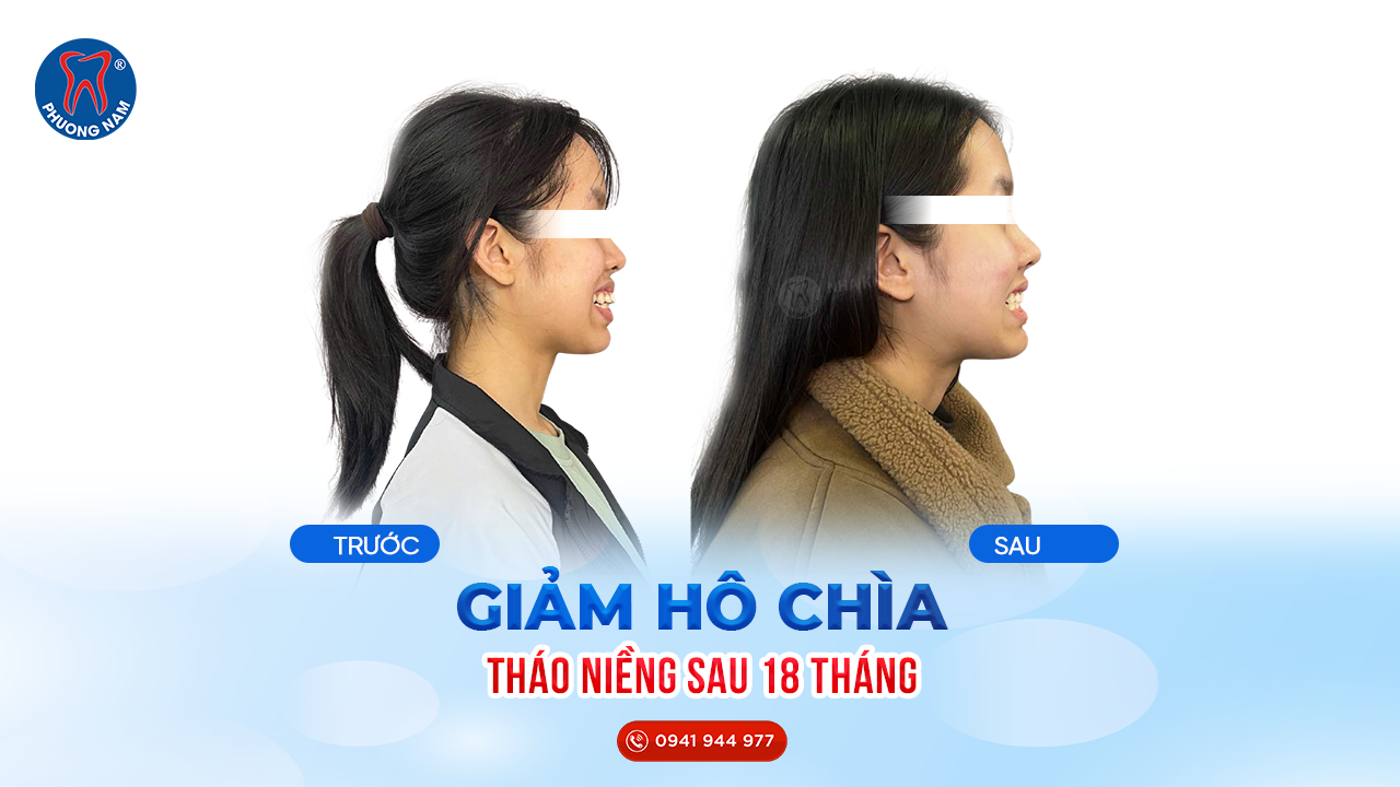 Niềng răng giảm hô chìa trước và sau 18 tháng tại Nha khoa Phương Nam