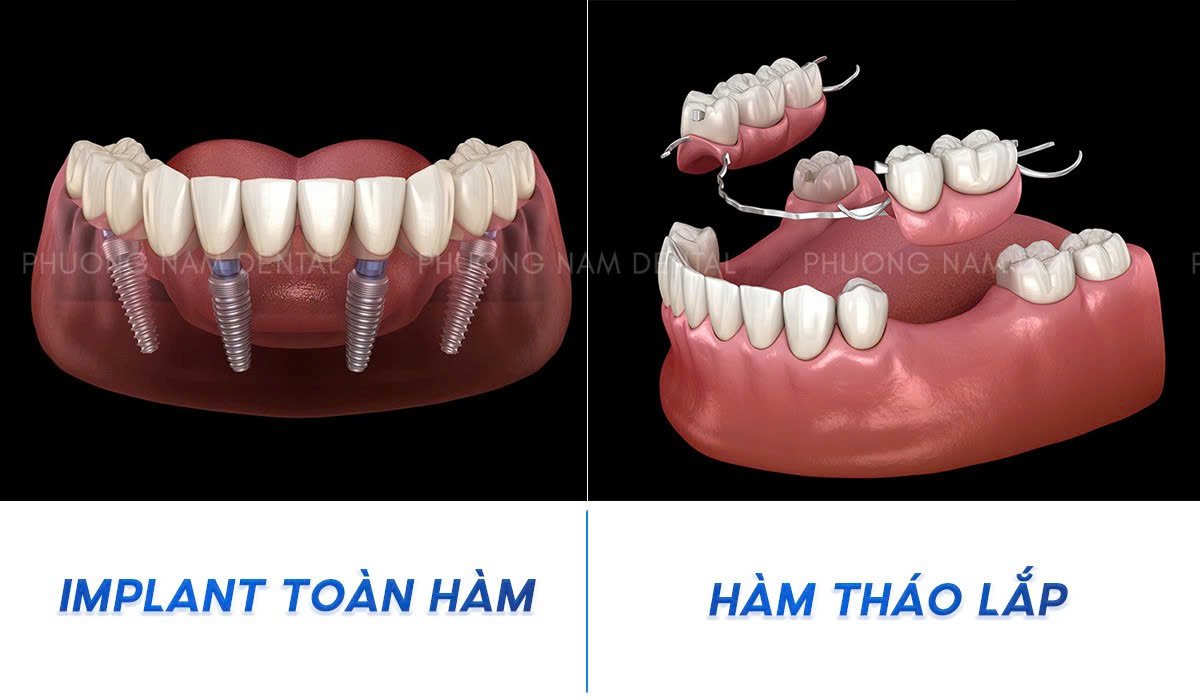 So sánh trồng răng Implant toàn hàm và hàm tháo lắp về khả năng ăn nhai và độ ổn định