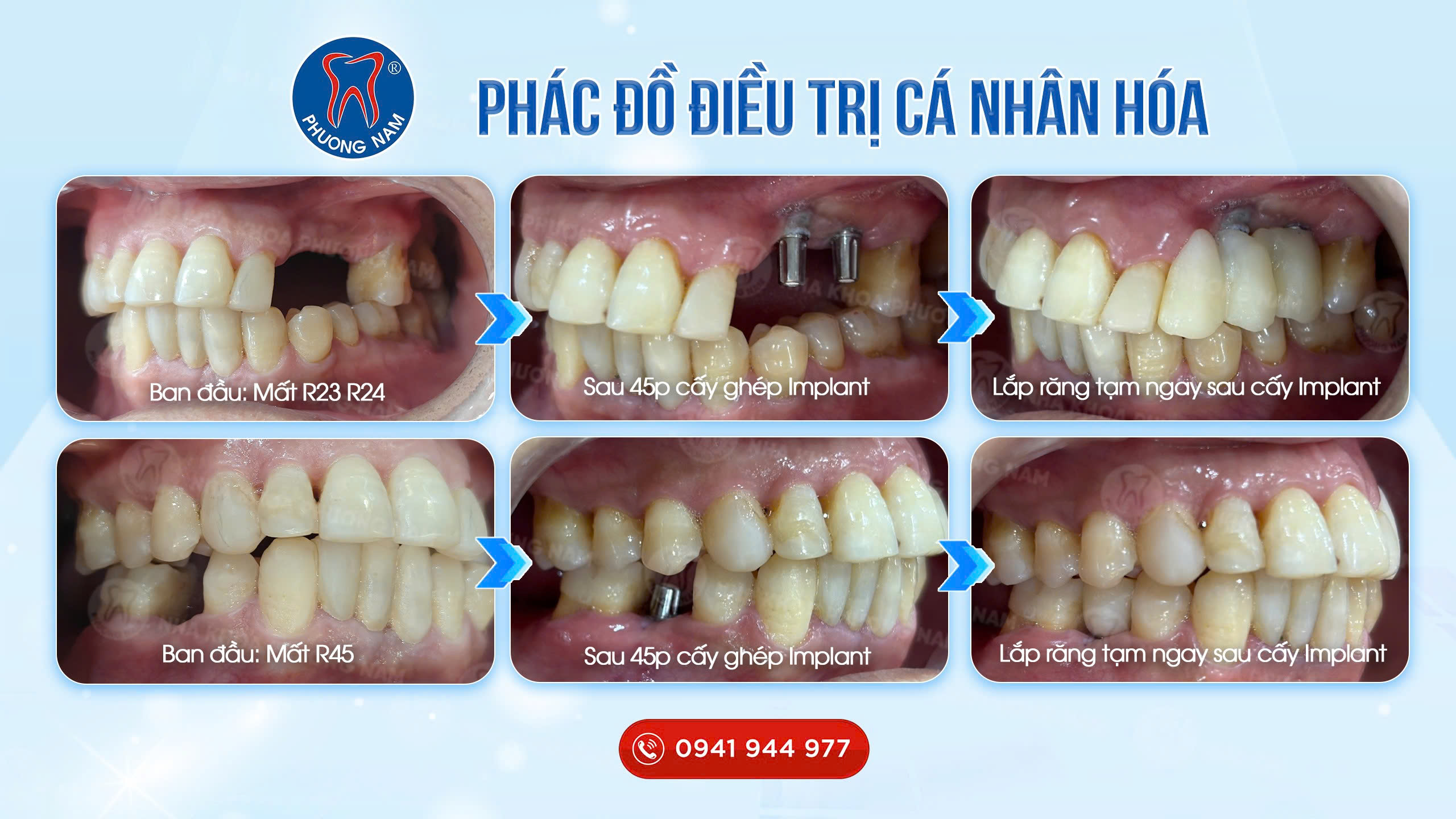 Trồng Implant và lắp răng tạm ngay sau khi cấy ghép tại Nha khoa Phương Nam