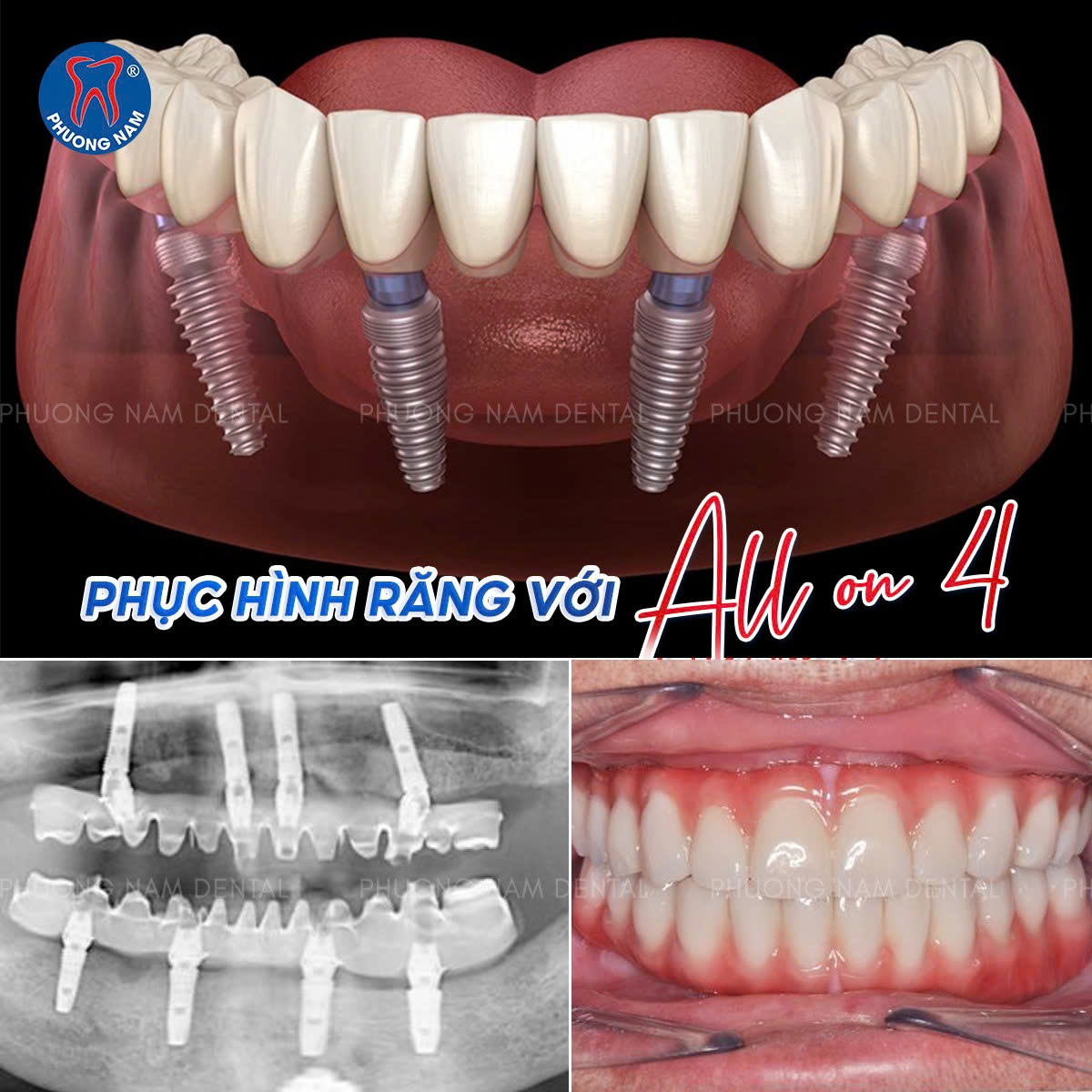Mô phỏng kỹ thuật trồng răng Implant toàn hàm All-on-4 giúp phục hồi khả năng ăn nhai