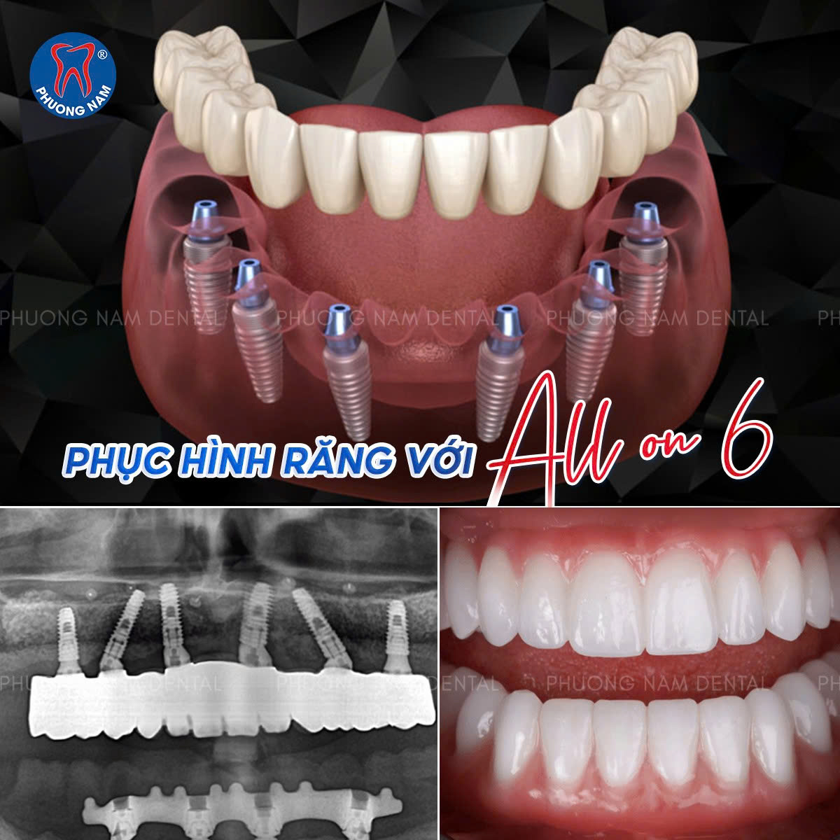 Mô phỏng kỹ thuật trồng răng Implant toàn hàm All-on-6 giúp phục hồi khả năng ăn nhai