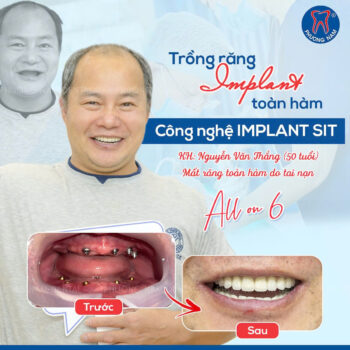 trong-rang-implant-toan-ham-all-on-6-truoc-sau.jpg