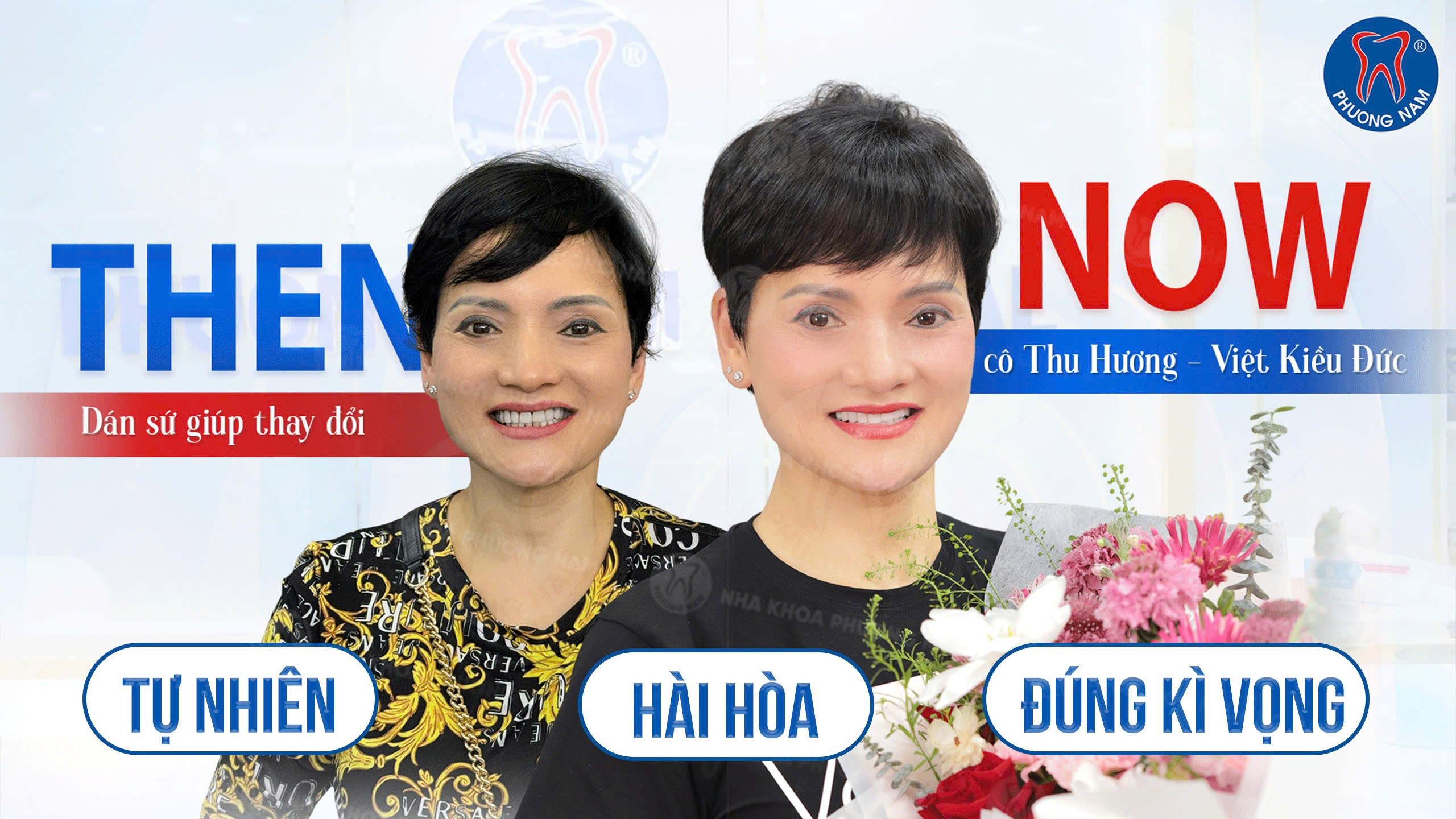 Cô Thu Hương Việt kiều Đức trồng Implant và làm răng sứ thẩm mỹ trước và sau tại Nha khoa Phương Nam