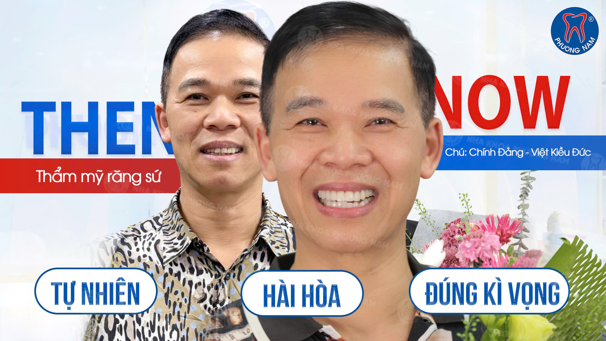 Chú Đảng Việt kiều Đức làm trồng implant kết hợp răng sứ thẩm mỹ trước và sau tại Nha khoa Phương Nam