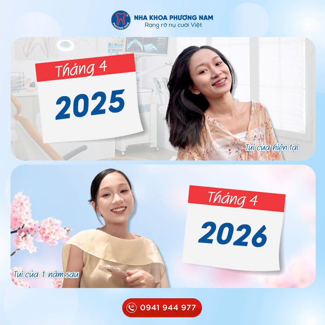 Niềng răng thay đổi nụ cười sau 1 năm từ 2025 đến 2026 tại Nha khoa Phương Nam