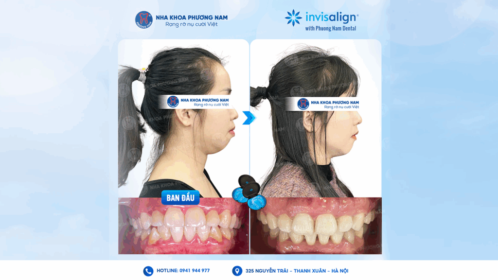 Niềng răng Invisalign cải thiện góc nghiêng trước sau tại Nha khoa Phương Nam