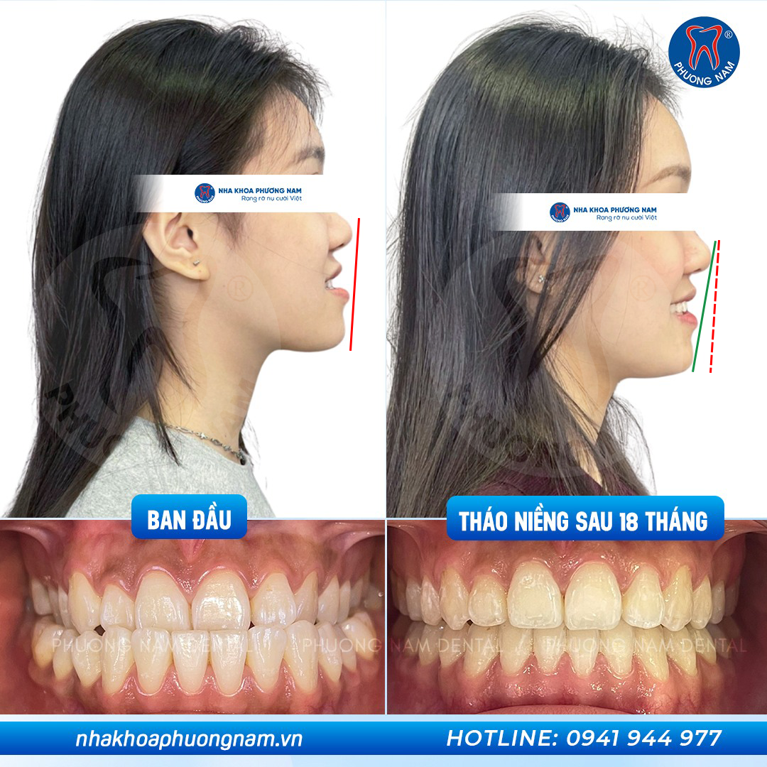 Niềng răng khớp cắn ngược cải thiện góc nghiêng sau 18 tháng tại Nha khoa Phương Nam