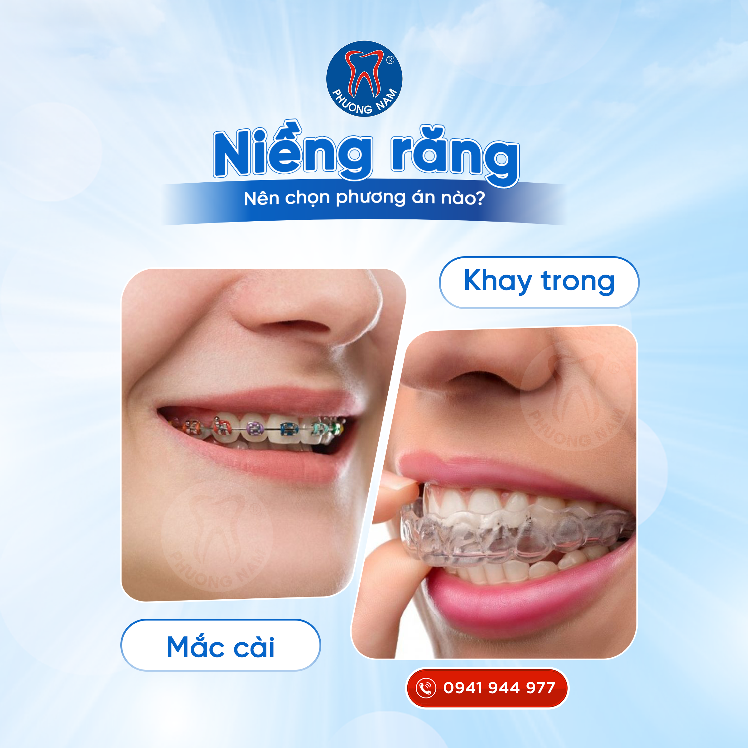 So sánh niềng răng mắc cài và Invisalign về thẩm mỹ và hiệu quả điều trị