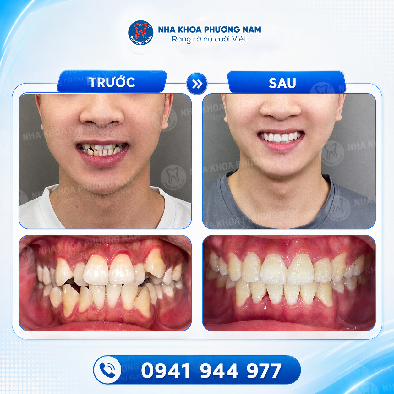 Trước sau niềng răng chen chúc, răng mọc lệch và sai khớp cắn tại Nha khoa Phương Nam