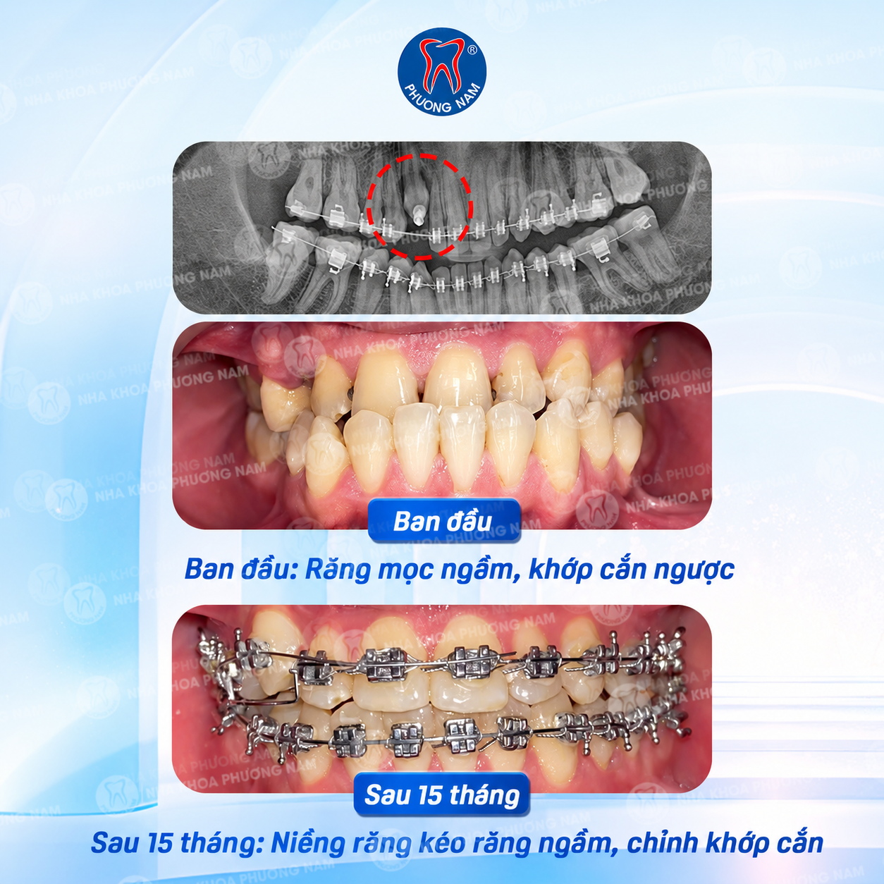 Răng mọc ngầm kèm khớp cắn ngược sau 15 tháng chỉnh nha tại Nha khoa Phương Nam