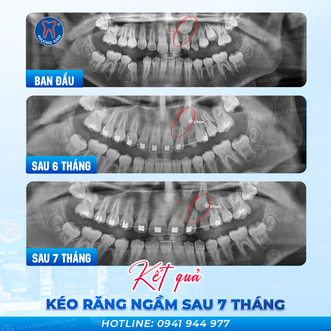 Răng mọc ngầm thay đổi sau 7 tháng chỉnh nha tại Nha khoa Phương Nam