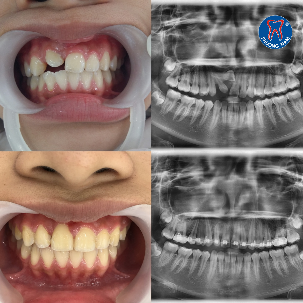 Kéo răng mọc ngầm bằng chỉnh nha tại Nha khoa Phương Nam