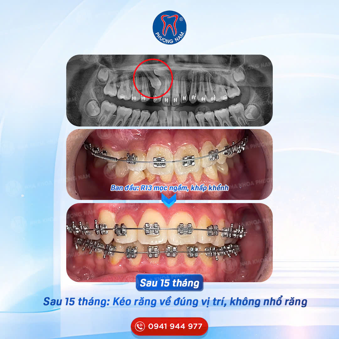 Răng nanh R13 mọc ngầm và khấp khểnh sau 15 tháng chỉnh nha tại Nha khoa Phương Nam